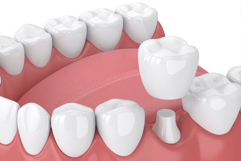 Dental Crowns in Oxon Hill