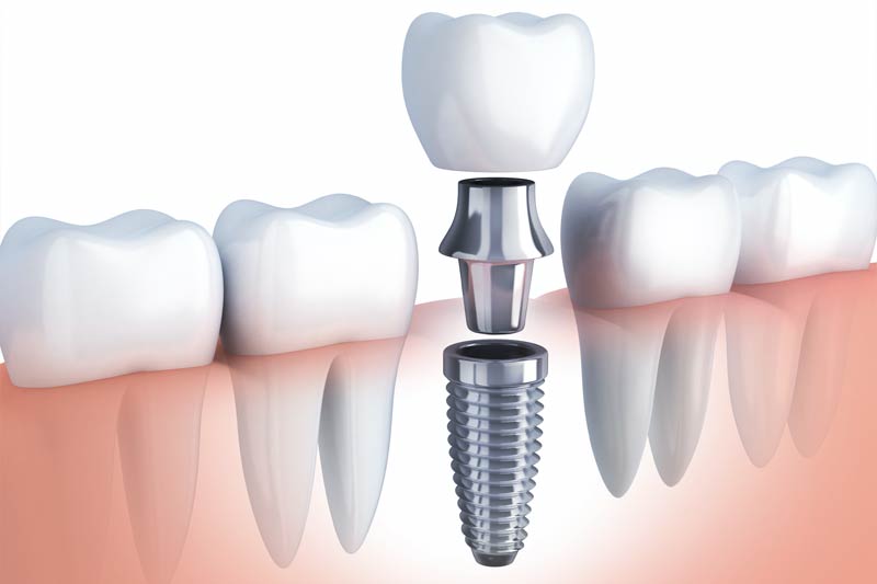 Implants Dentist in Oxon Hill