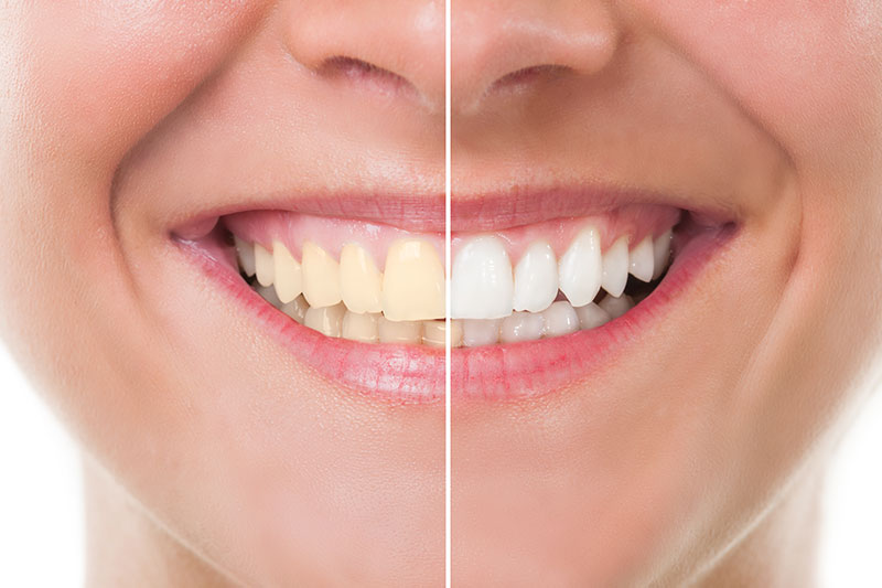 Teeth Whitening in Oxon Hill