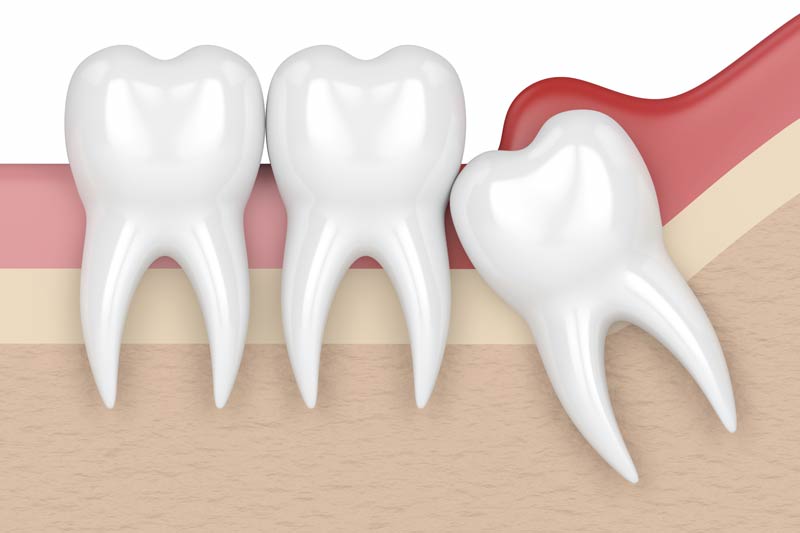 Wisdom Tooth Removal in Oxon Hill